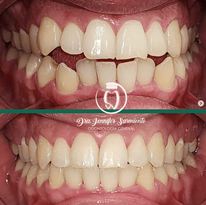 Caso antes y después de alineación dental, tratado por la Dra. Jennifer Sarmiento en Dental Magic