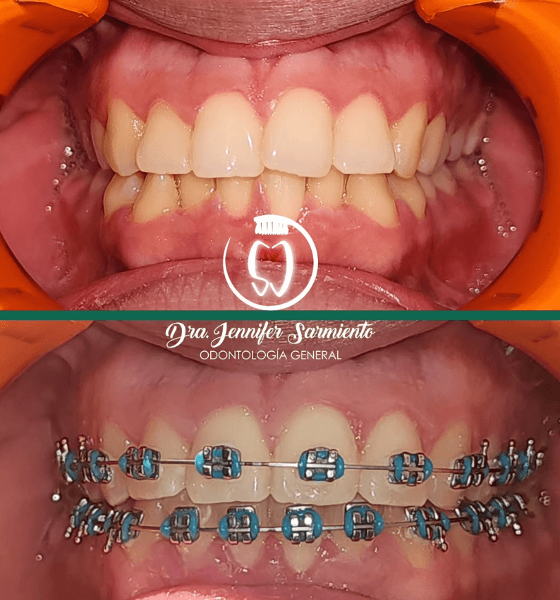 Caso antes y después de ortodoncia, tratado por la Dra. Jennifer Sarmiento en Dental Magic