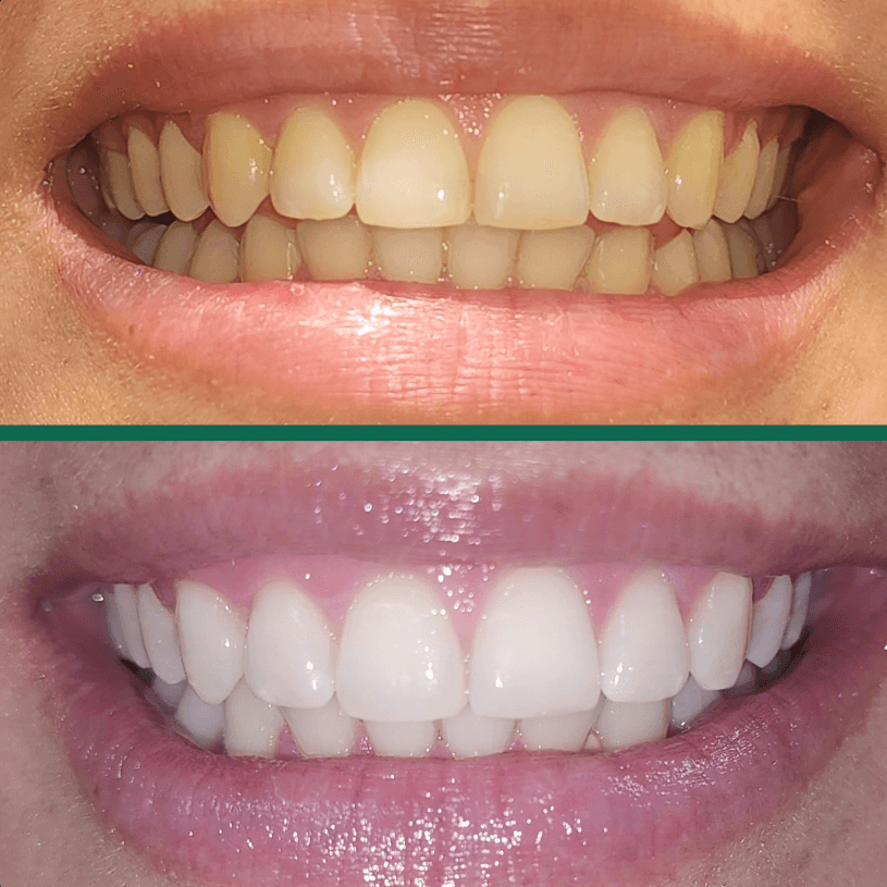 Caso antes y después de blanqueamiento dental, tratado por la Dra. Jennifer Sarmiento en Dental Magic