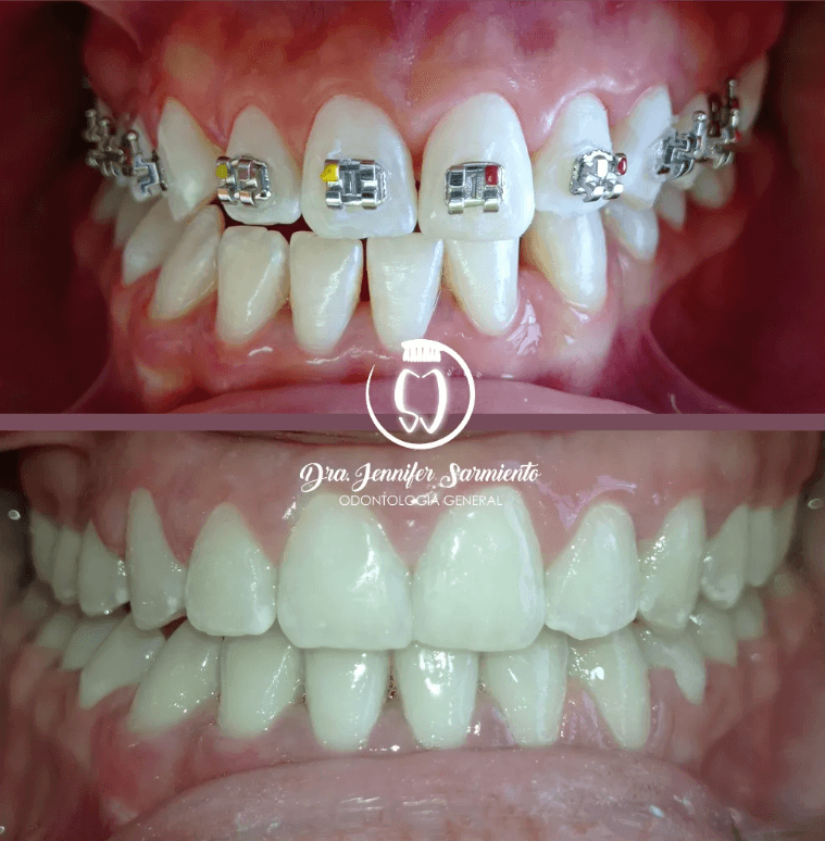 Caso antes y después de resultado final de ortodoncia, tratado por la Dra. Jennifer Sarmiento en Dental Magic