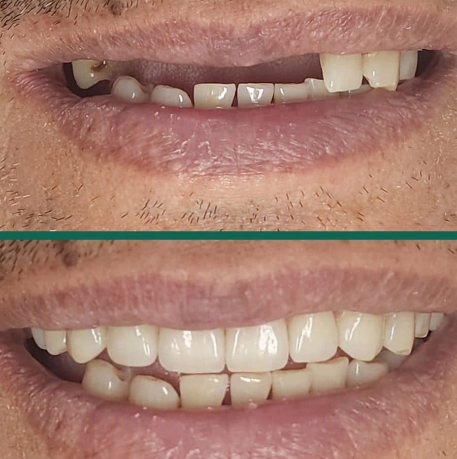 Caso antes y después de restauración dental en Dental Magic