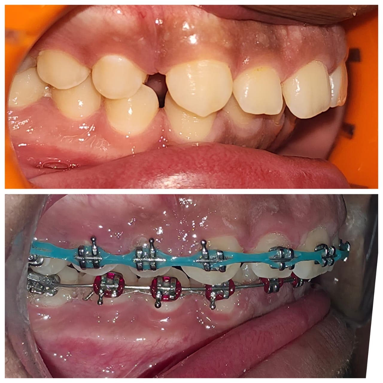 Caso antes y después de tratamiento de ortodoncia en Dental Magic