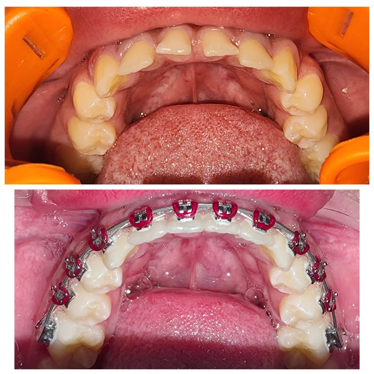 Caso antes y después de ortodoncia vista oclusal en Dental Magic