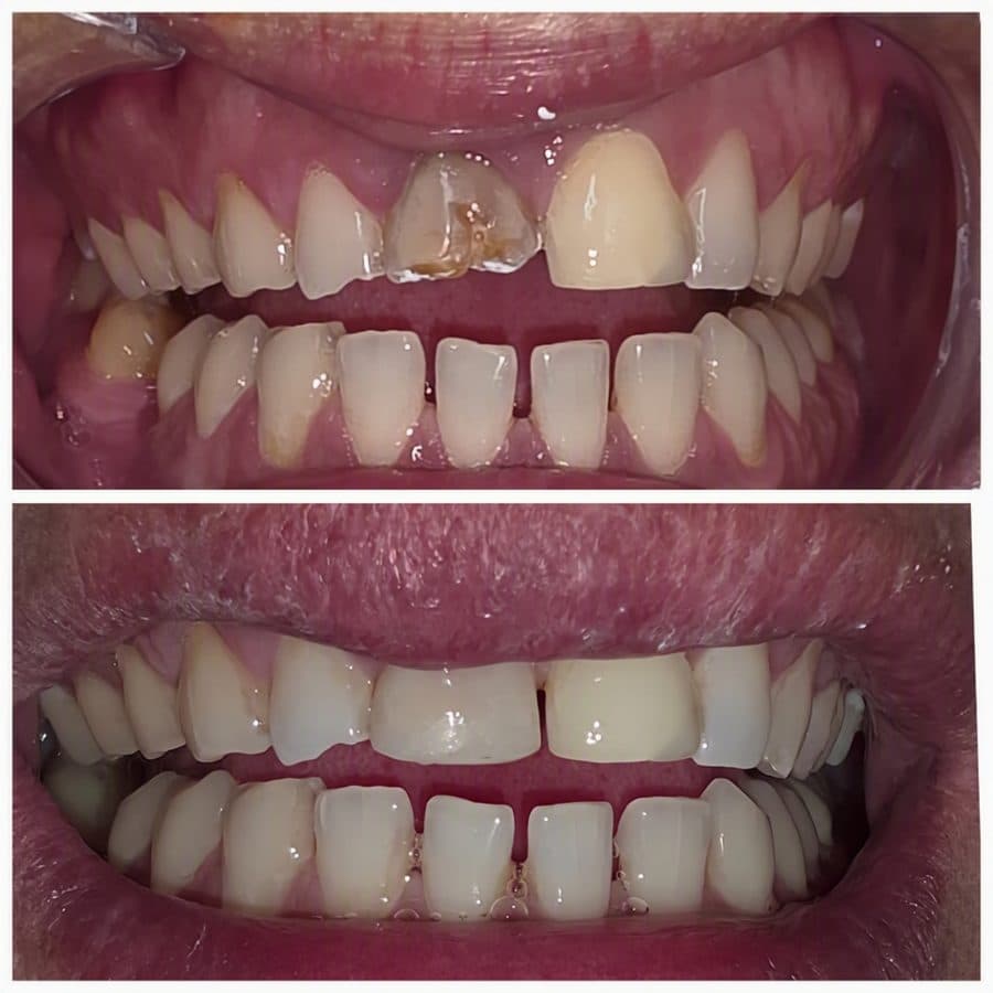 Caso antes y después de restauración dental en Dental Magic
