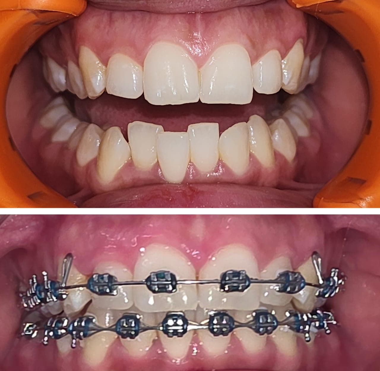 Caso antes y después de ortodoncia con brackets en Dental Magic