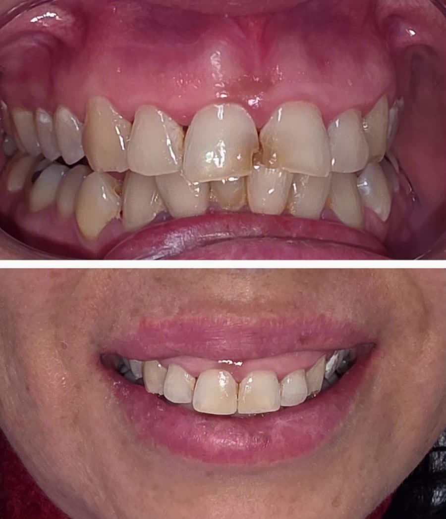 Caso antes y después de restauración dental en Dental Magic