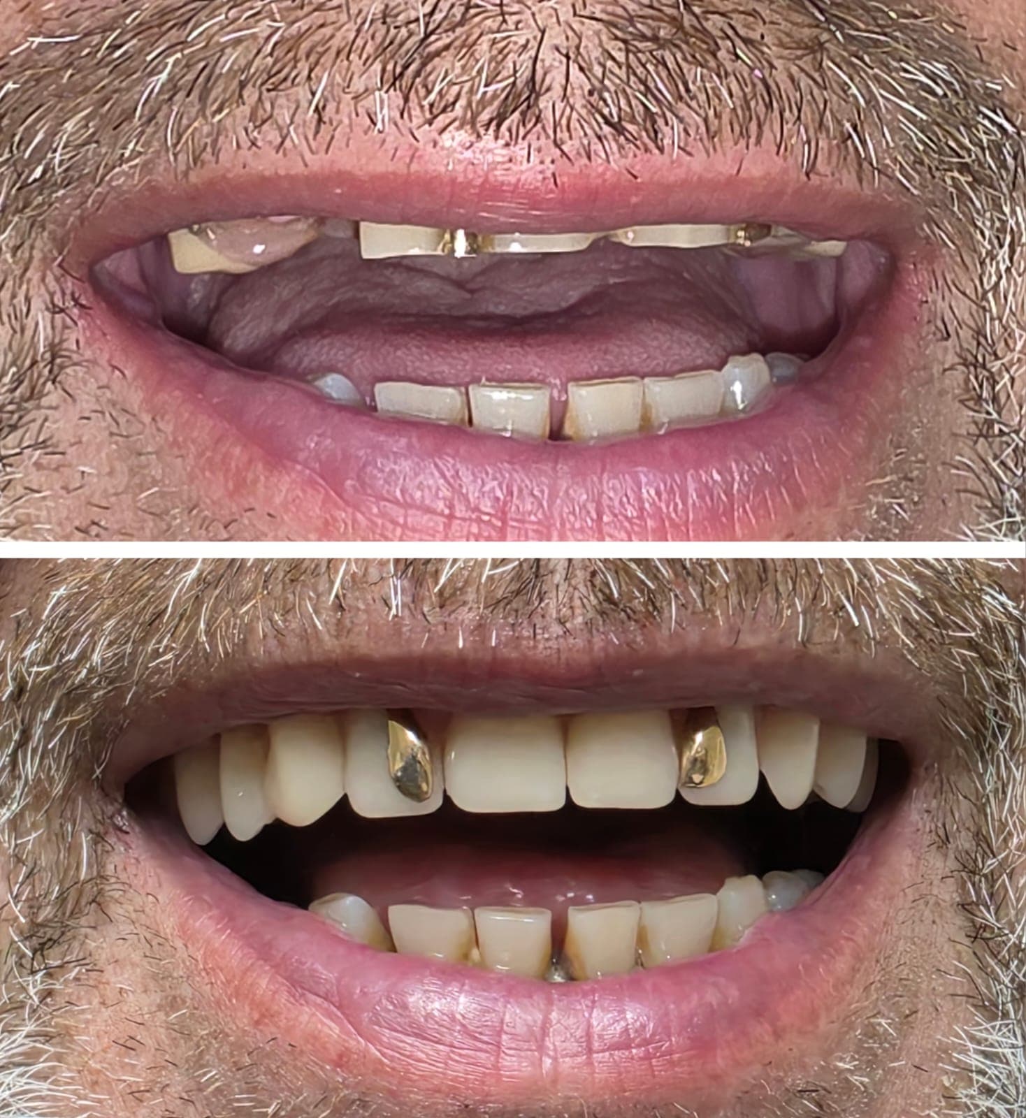 Caso antes y después de rehabilitación dental en Dental Magic