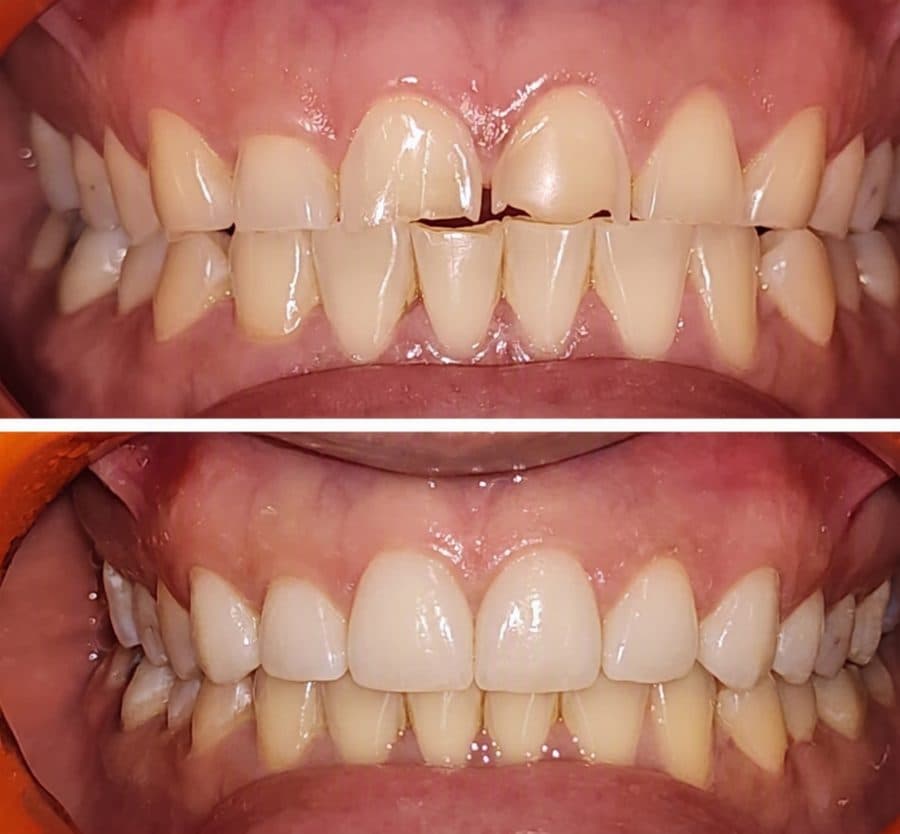 Caso antes y después de restauración dental en Dental Magic